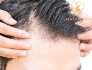 عيادة لزراعة الشعر في جدة