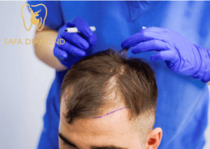 ارقام عيادات زراعة الشعر في جدة