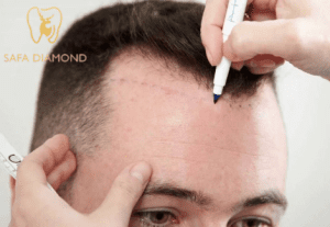 تكلفة زراعة الشعر 2024