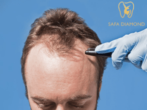 اسعار عمليات زراعة الشعر