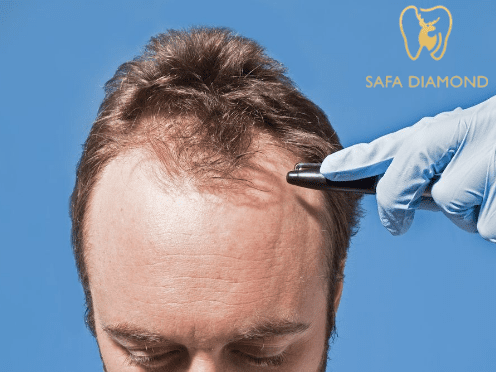 افضل عيادة زراعة شعر بالرياض
