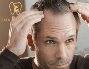 تكلفة زراعة الشعر 2024