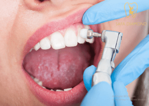 أفضل عروض تجميل الأسنان : عيادة صفا الماسي 0546444116
