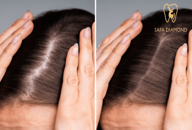 عروض تجديد الشعر والعناية به في عيادة صفا الماسي: 0546444116