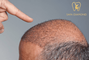 تكلفة زراعة الشعر في جدة 2025: 0546444116