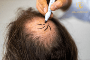 أفضل دكتور زراعة شعر في الرياض: 0546444116