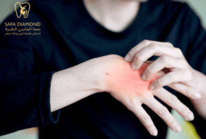 علاج الحساسية الجلدية: 0546444116