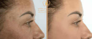 افضل عيادة لعلاج التصبغات الجلدية العميقة: 0546444116