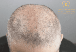 كم تستغرق عملية زراعة الشعر: 0546444116