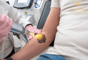 تكلفة إزالة الوشم بالليزر في السعودية : 0546444116