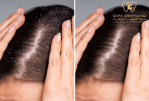 علاج تساقط الشعر مضمون 100%: 0546444116