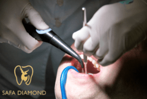 سعر تنظيف الأسنان في جدة: 0546444116
