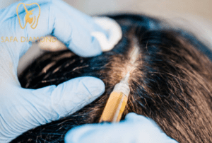 زراعة الشعر باستخدام التقنيات الحديثة: 0546444116