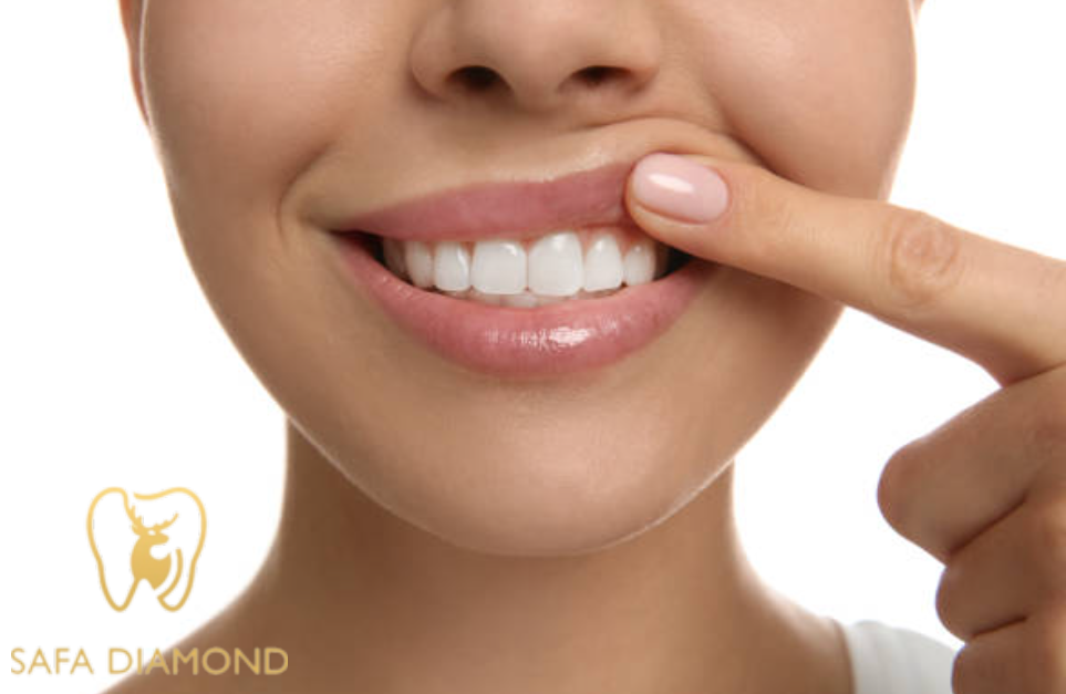 ابتسامة هوليود المتحركة سعرها: 0546444116