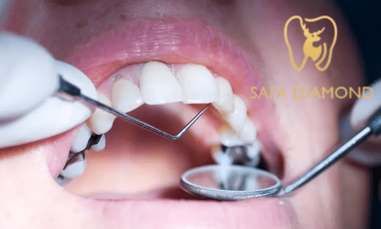 أنواع حشوات الأسنان الدائمة: 0546444116