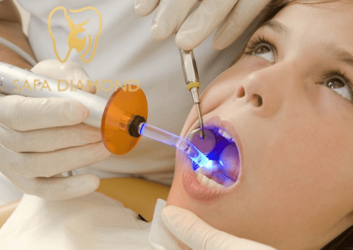 افضل عيادات لحشوات الأسنان في جدة: 0546444116