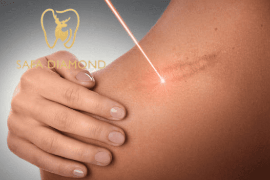 افضل عيادة في السعودية لإزالة آثار الجروح والحروق: 0546444116