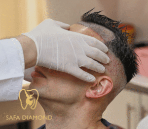 الصلع الوراثي وطرق علاجه في عيادة صفا الماسي: 0546444116