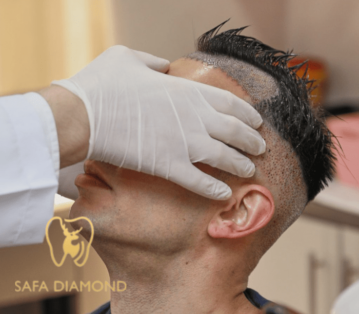 علاج الصلع الوراثي جدة: 0546444116