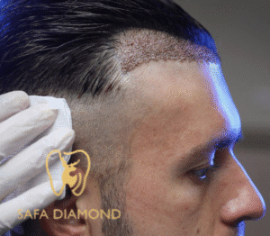 دليلك لاختيار عيادة زراعة شعر موثوقة في السعودية: 0546444116