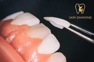 كل ما تحتاج معرفته قبل تركيب عدسات الأسنان التجميلية: 0546444116