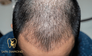 افضل عيادة متخصصه في علاج الصلع الوراثي :0546444116