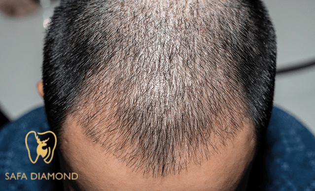 افضل عيادة متخصصه في علاج الصلع الوراثي :0546444116