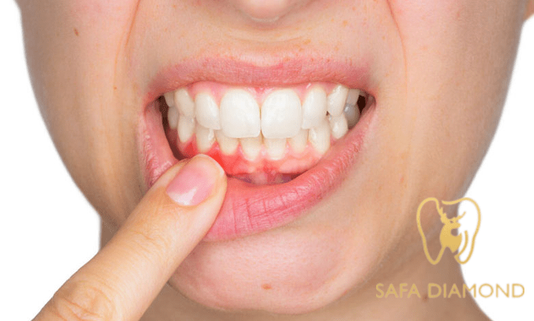 ما هو تجميل اللثة؟ وهل هو ضروري لجمال الابتسامة: 0546444116