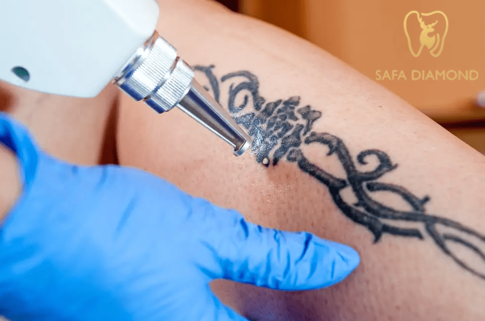 افضل عيادة في جدة لإزالة التاتو: 0546444116