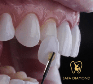 ابتسامة هوليود المتحركة سعرها: 0546444116