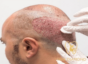تُعتبر زراعة الشعر في المملكة العربية السعودية من أوائل الدول العربية تقدمًا في المجال الطبي، وذلك بفضل حرصها المستمر على استقطاب نخبة الأطباء من مختلف دول العالم
