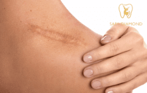 علاج الندبات بعد العمليات الجراحية: 0546444116