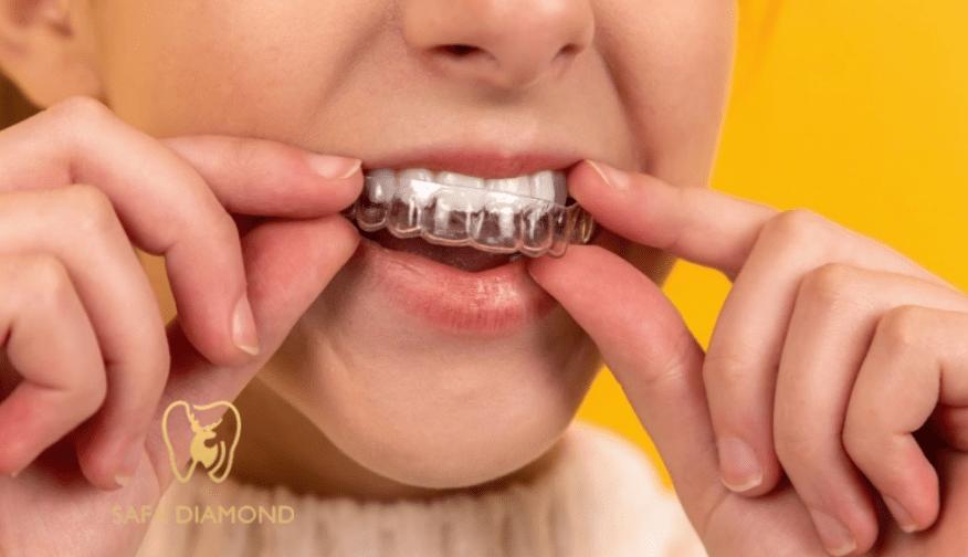 هل التقويم الشفاف يعالج بروز الأسنان: 0546444116