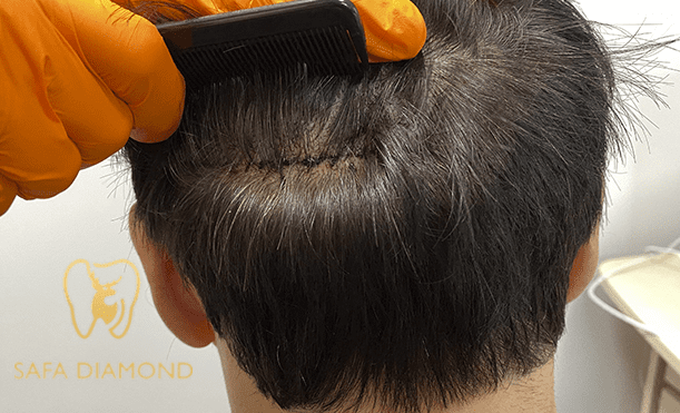 عيادة متخصص في زراعة الشعر: 0546444116