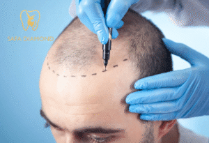 افضل عيادة متخصصه في علاج الصلع الوراثي :0546444116