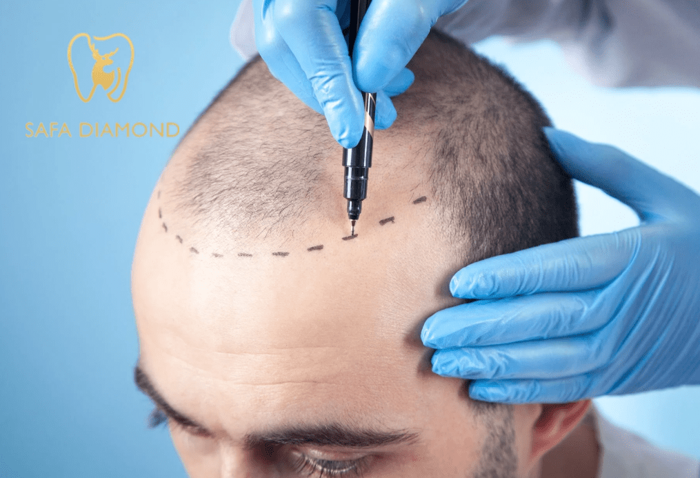 كيف تختار عيادة لزراعة الشعر جدة: 0546444116
