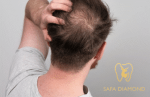 دليل زراعة الشعر بتقنية الشريحة (FUT): الفوائد والإجراء: 0546444116