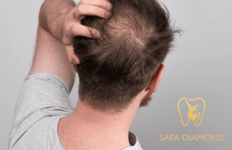 أسعار زراعة الشعر في السعودية لعام 2026: دليل شامل: 0546444116
