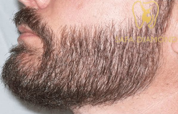 كل ما تريد معرفته عن زراعة شعر اللحية: 0546444116
