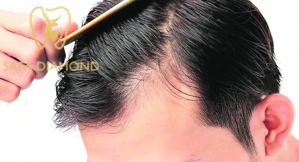 احسن دكتور متخصص في علاج الشعر في جدة: 0546444116
