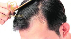 الصلع الوراثي وطرق علاجه في عيادة صفا الماسي: 0546444116