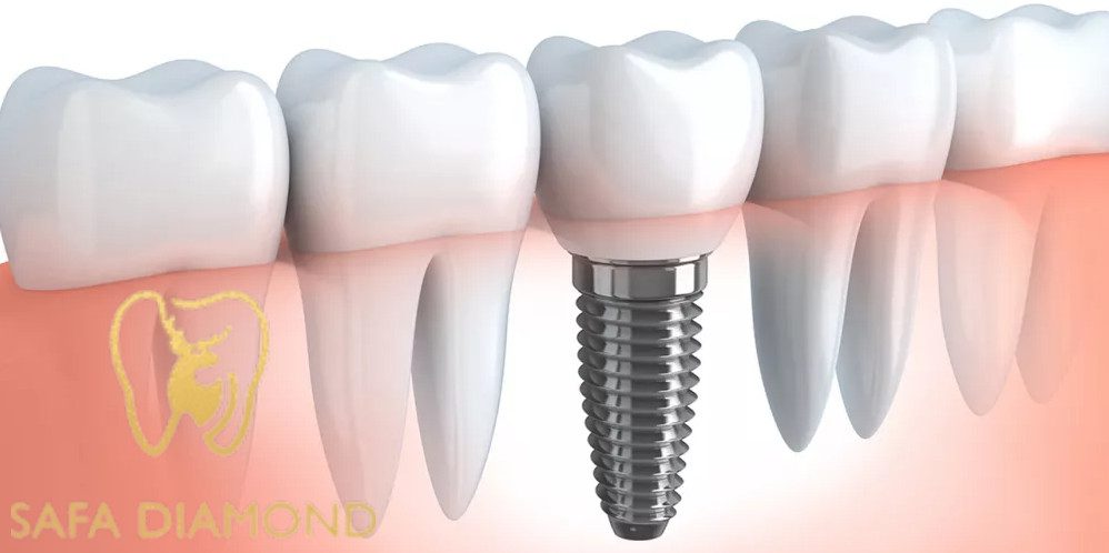 زراعة الأسنان في الفك العلوي: 0546444116