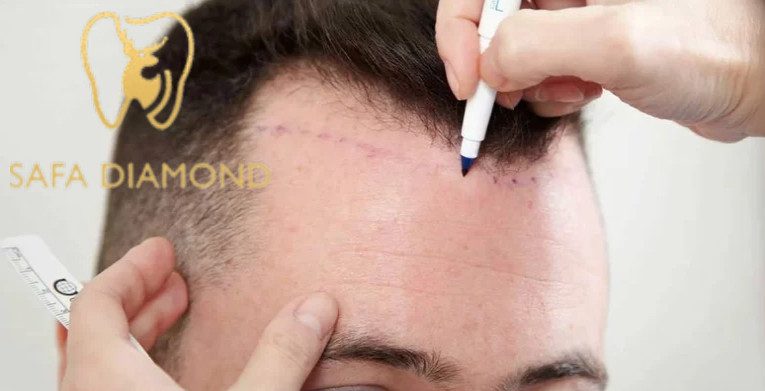الصلع الوراثي وطرق علاجه في عيادة صفا الماسي: 0546444116
