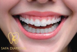هل التقويم الشفاف يعالج بروز الأسنان: 0546444116هل التقويم الشفاف يعالج بروز الأسنان: 0546444116
