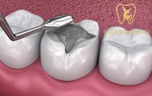 أنواع حشوات الأسنان الدائمة: 0546444116