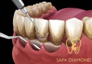 سعر تنظيف الجير في السعودية: 0546444116