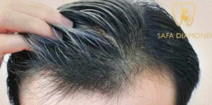 مركز زراعة الشعر بجدة: 0546444116