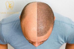 مركز زراعة الشعر بجدة: 0546444116