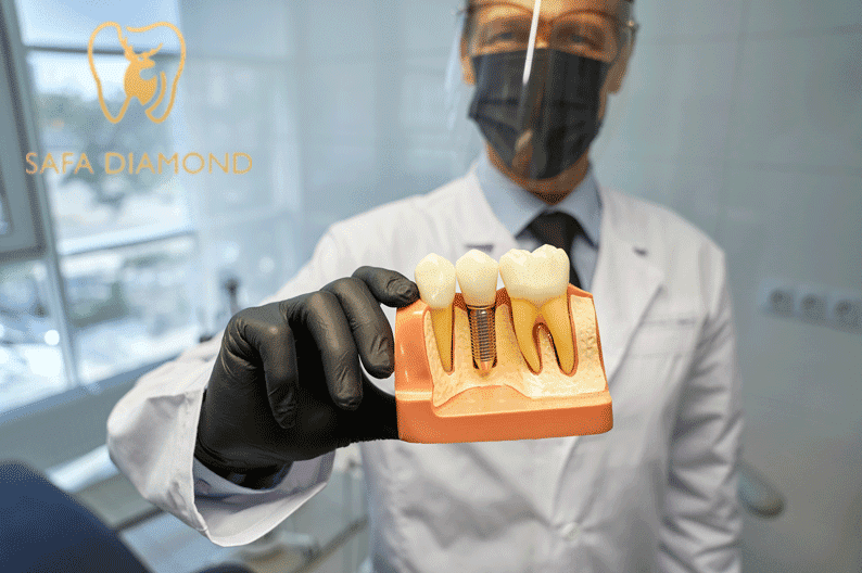 تكلفة زراعة الأسنان في جدة: 0546444116