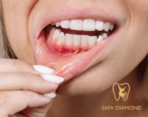 عيادة متخصصة في علاج التهابات اللثة والعصب: 0546444116